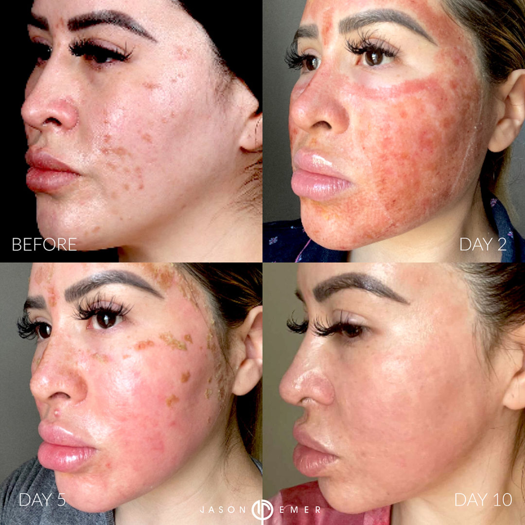 CO2 Laser Resurfacing and Chemical Peel Before and After Photo by Dr. Emer and Dr. Sanan in West Hollywood California