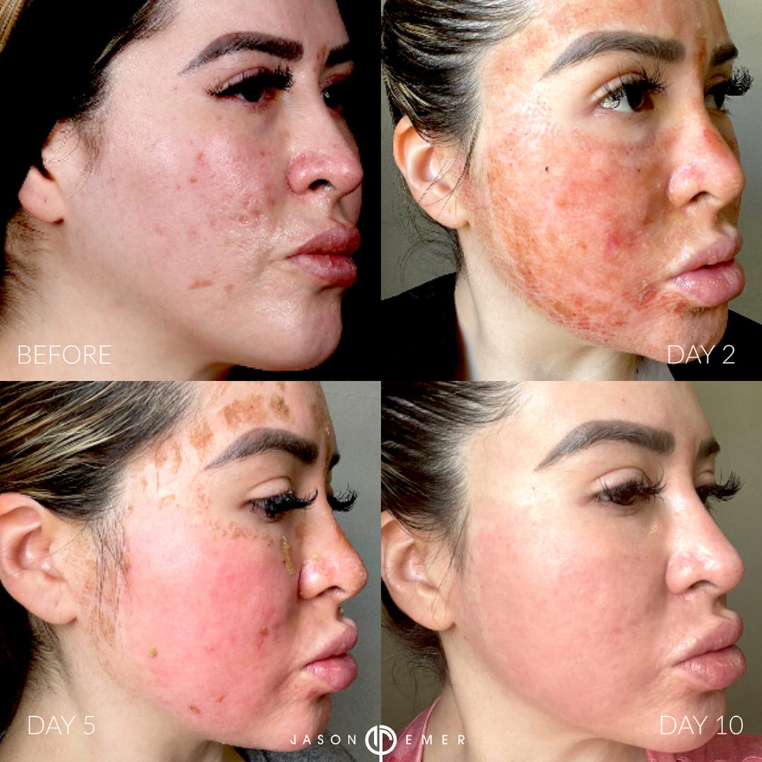 CO2 Laser Resurfacing and Chemical Peel Before and After Photo by Dr. Emer and Dr. Sanan in West Hollywood California