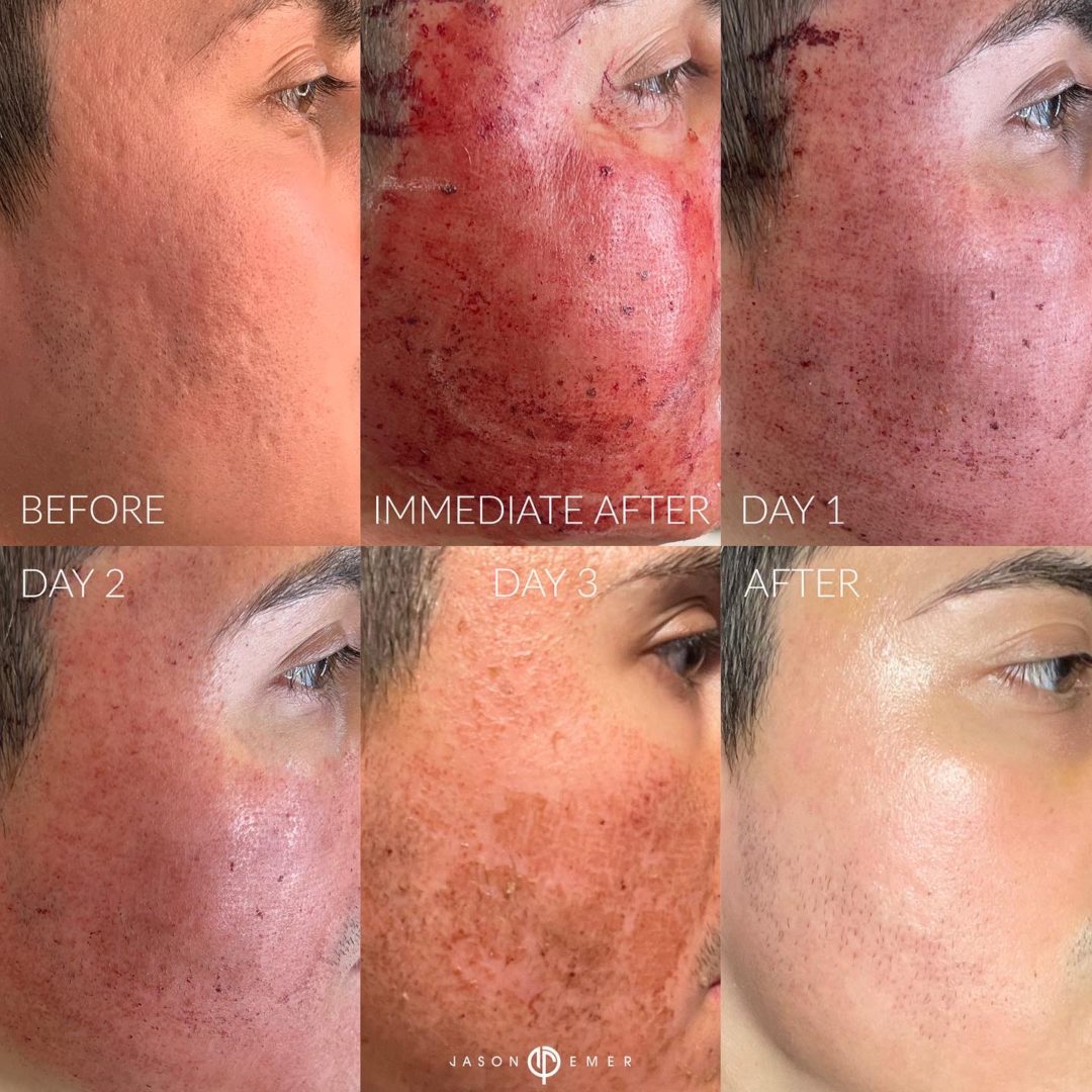 CO2 Laser Resurfacing Before and After Photo by Dr. Emer and Dr. Sanan in West Hollywood California