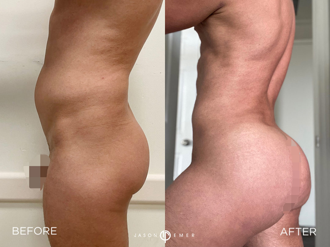 Fat Grafting and Butt Before and After Photo by Dr. Emer and Dr. Sanan in West Hollywood California