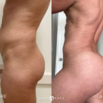 Fat Grafting and Butt Before and After Photo by Dr. Emer and Dr. Sanan in West Hollywood California