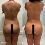 Fat Grafting to Buttocks Before and After Photo by Dr. Emer and Dr. Sanan in West Hollywood California