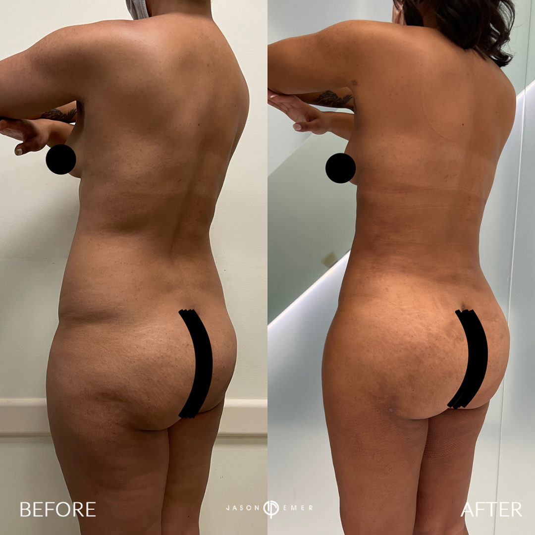 Fat Grafting to Buttocks Before and After Photo by Dr. Emer and Dr. Sanan in West Hollywood California