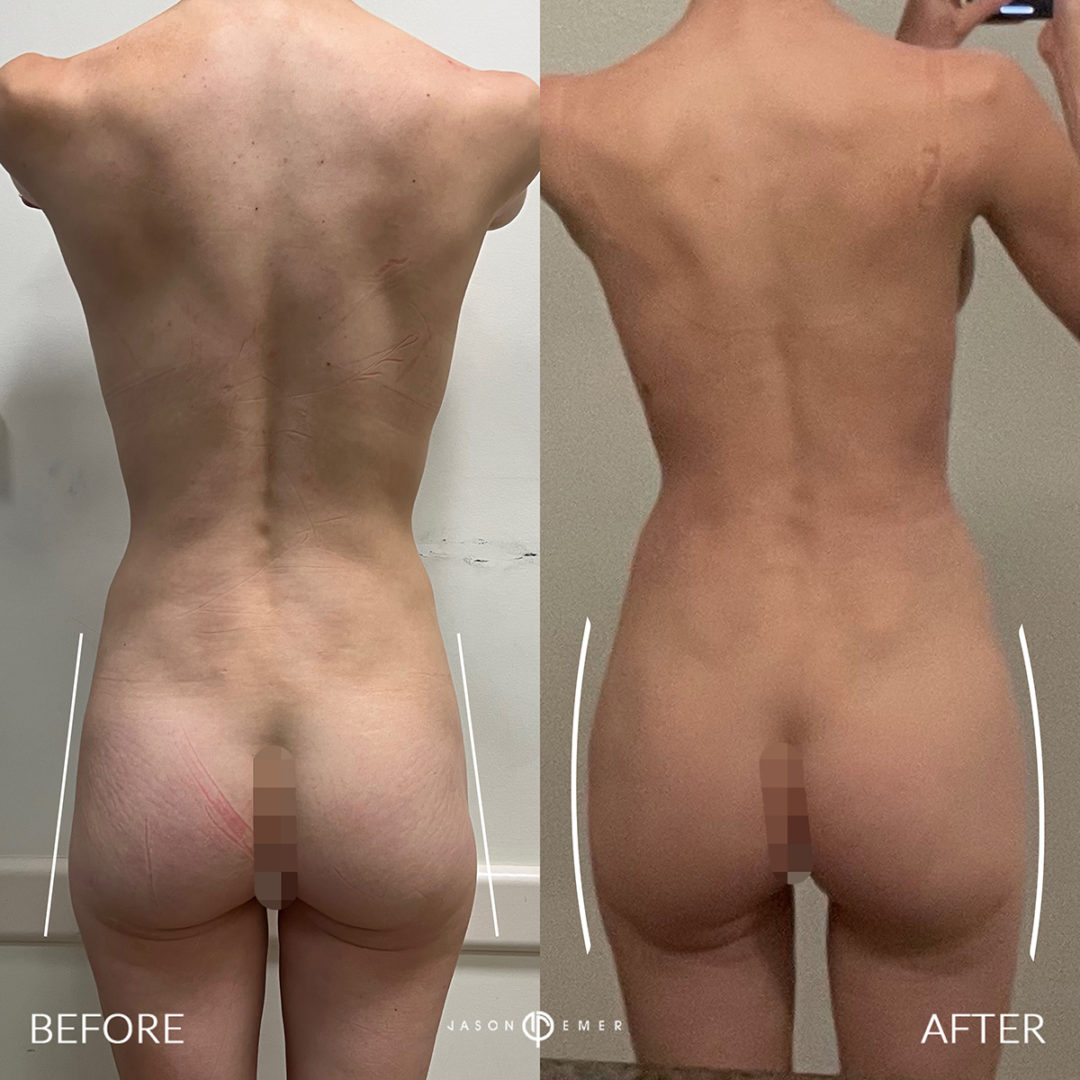 Fat Grafting to Hip Dips Before and After Photo by Dr. Emer and Dr. Sanan in West Hollywood California