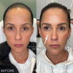 Female Facial Sculpting Before and After Photo by Dr. Emer and Dr. Sanan in West Hollywood California