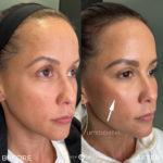 Female Facial Sculpting Before and After Photo by Dr. Emer and Dr. Sanan in West Hollywood California