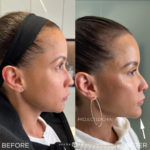 Female Facial Sculpting Before and After Photo by Dr. Emer and Dr. Sanan in West Hollywood California