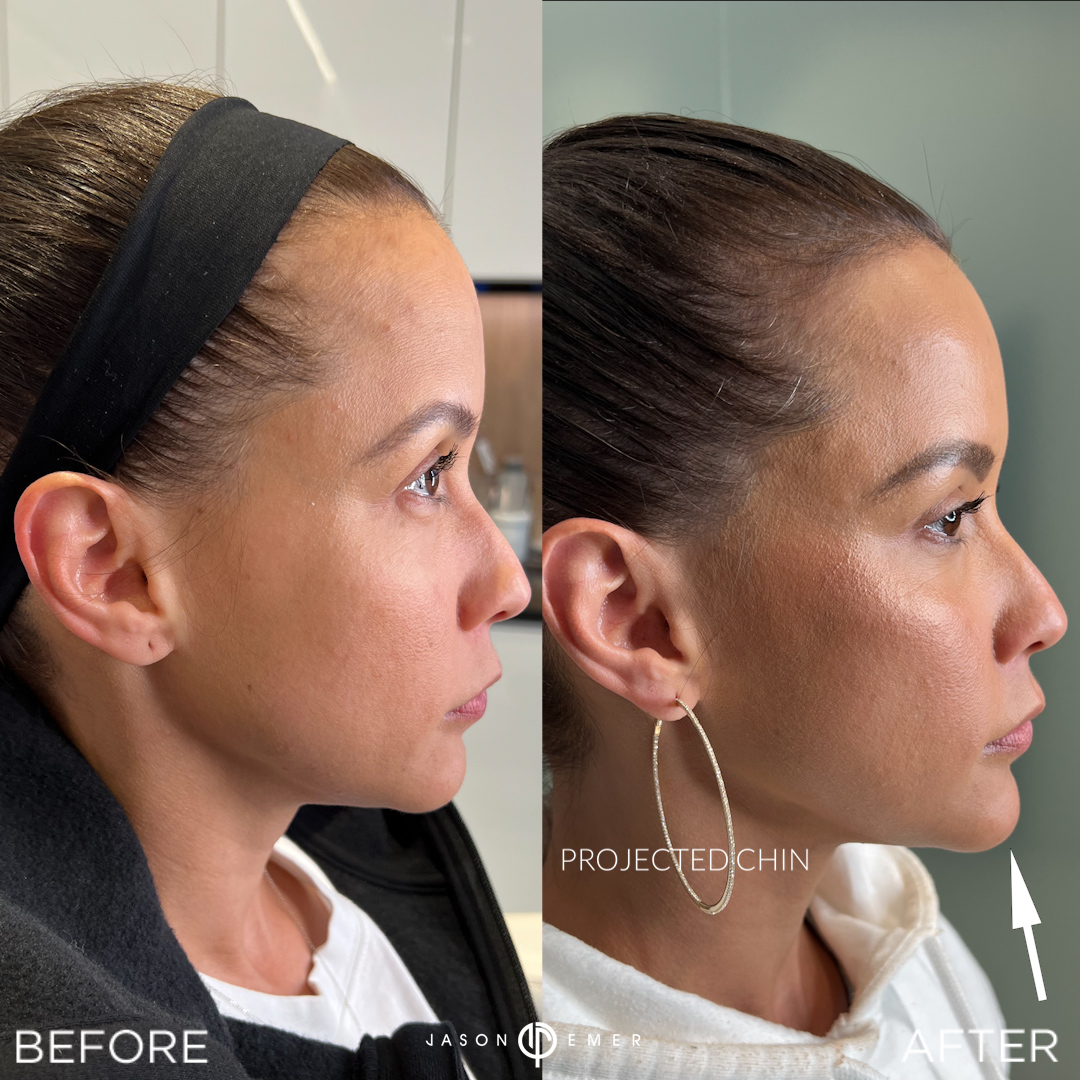 Female Facial Sculpting Before and After Photo by Dr. Emer and Dr. Sanan in West Hollywood California