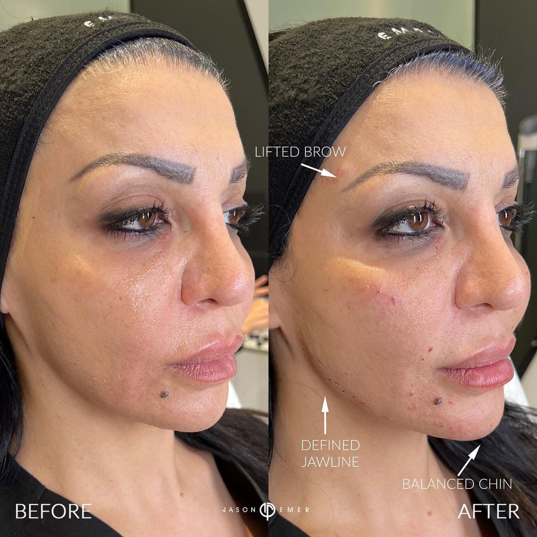 Female Facial Sculpting Before and After Photo by Dr. Emer and Dr. Sanan in West Hollywood California