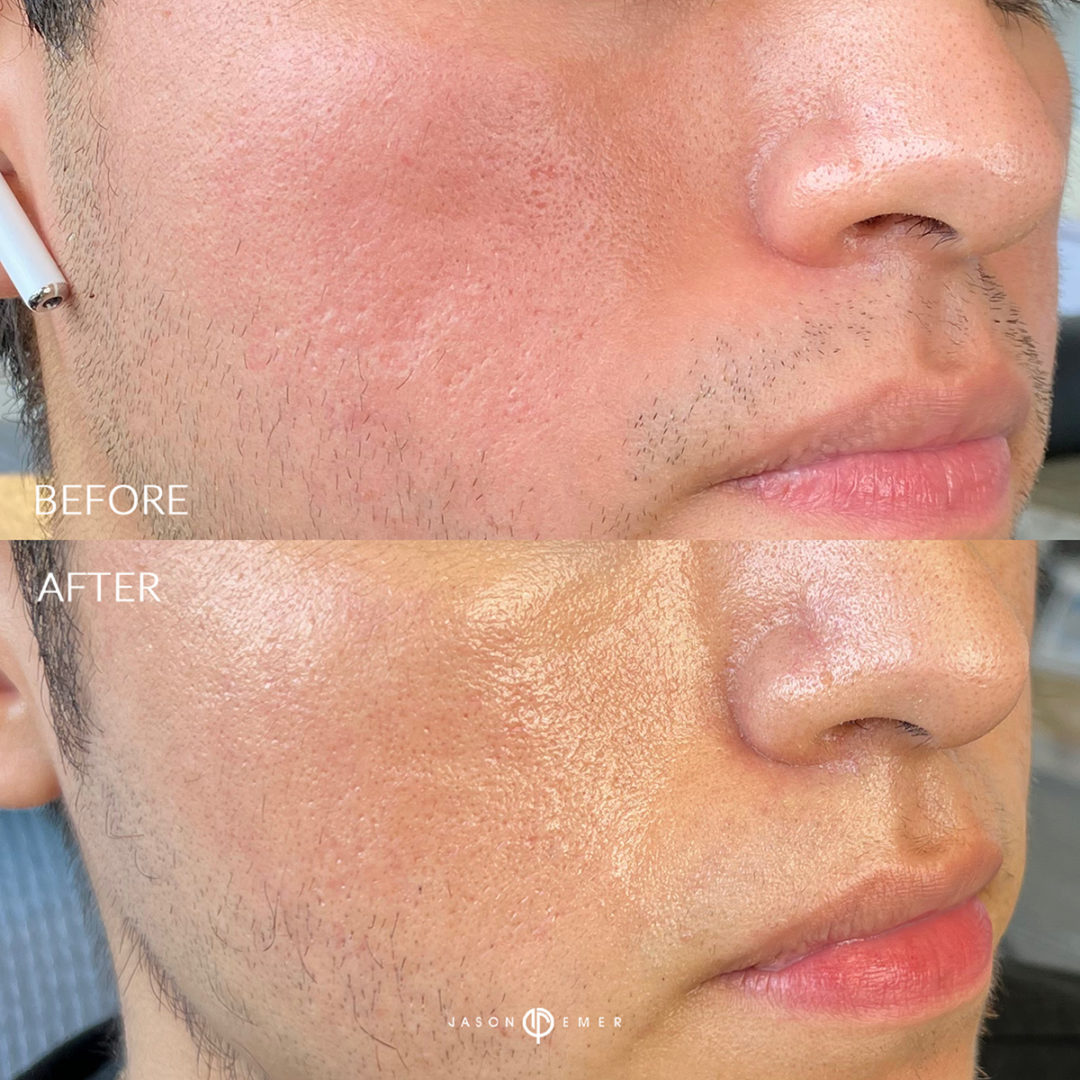 Microneedling Before and After Photo by Dr. Emer and Dr. Sanan in West Hollywood California