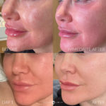 Laser Skin Resurfacing Before and After Photo by Dr. Emer and Dr. Sanan in West Hollywood California