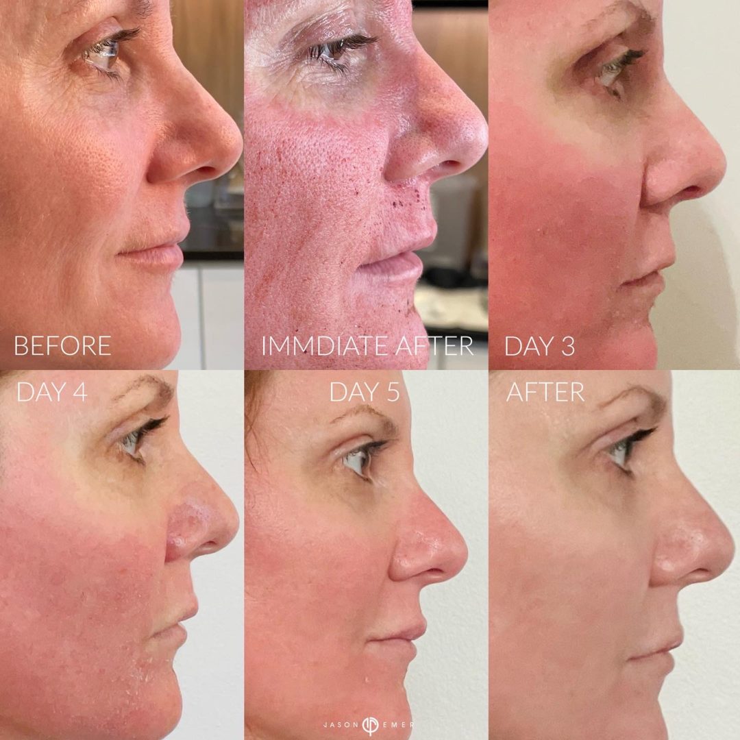 Laser Resurfacing Before and After Photo by Dr. Emer and Dr. Sanan in West Hollywood California