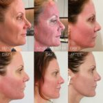 Laser Resurfacing Before and After Photo by Dr. Emer and Dr. Sanan in West Hollywood California