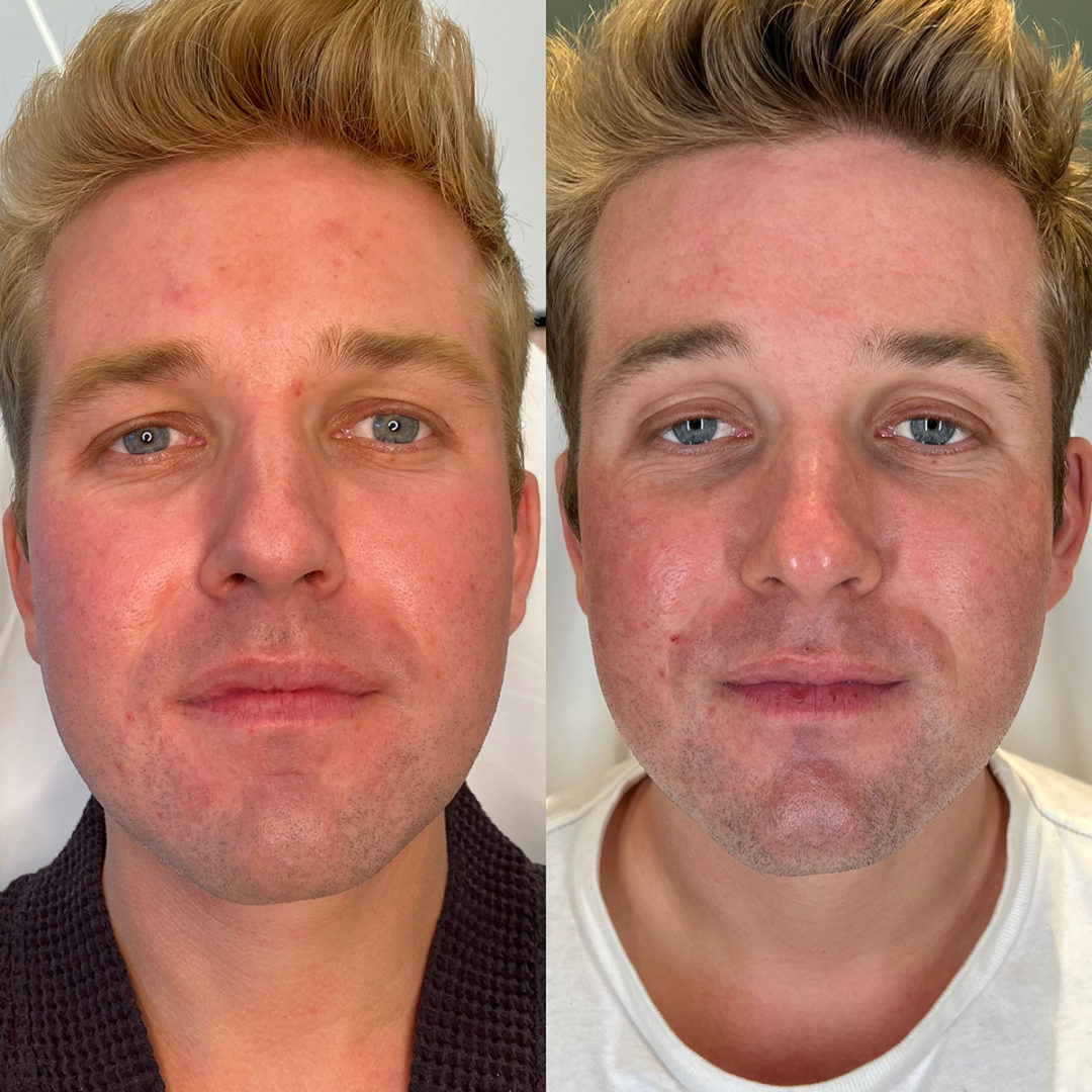 CO2 Laser Resurfacing Before and After Photo by Dr. Emer and Dr. Sanan in West Hollywood California