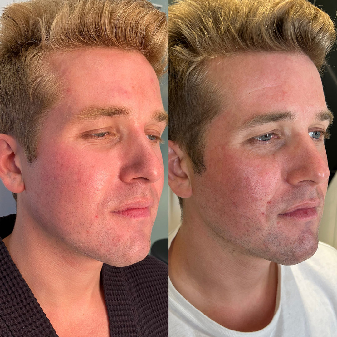 CO2 Laser Resurfacing Before and After Photo by Dr. Emer and Dr. Sanan in West Hollywood California