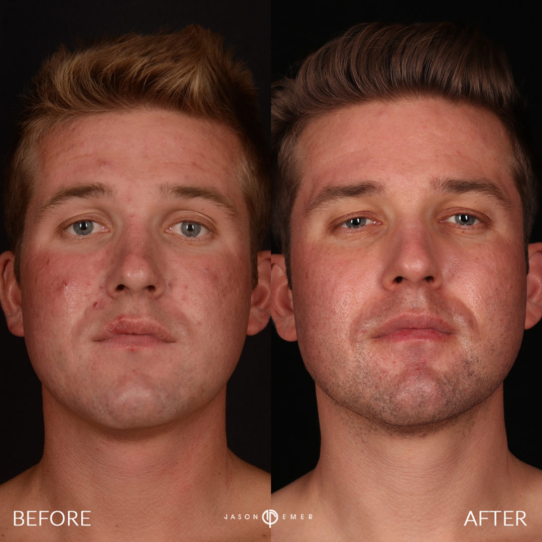 CO2 Laser Resurfacing Before and After Photo by Dr. Emer and Dr. Sanan in West Hollywood California