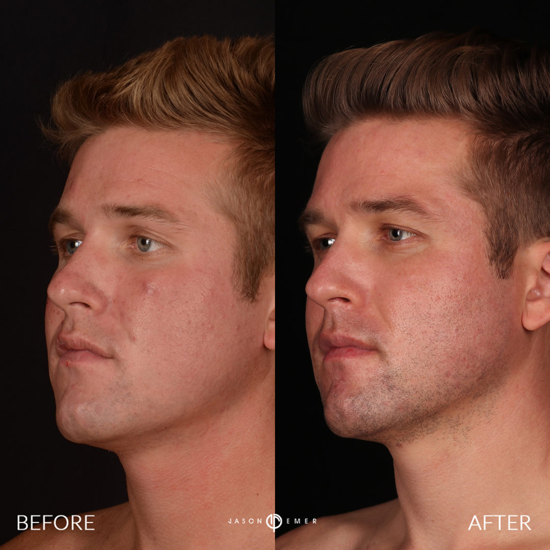 CO2 Laser Resurfacing Before and After Photo by Dr. Emer and Dr. Sanan in West Hollywood California