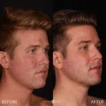 CO2 Laser Resurfacing Before and After Photo by Dr. Emer and Dr. Sanan in West Hollywood California