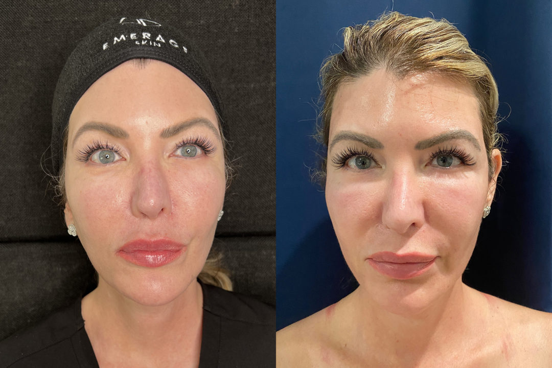 Mesh Brow Threads Before and After Photo by Dr. Emer and Dr. Sanan in West Hollywood California