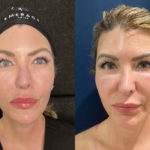 Mesh Brow Threads Before and After Photo by Dr. Emer and Dr. Sanan in West Hollywood California