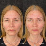 Mesh Brow Threads Before and After Photo by Dr. Emer and Dr. Sanan in West Hollywood California