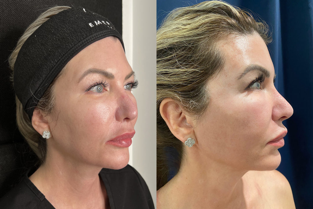 Mesh Brow Threads Before and After Photo by Dr. Emer and Dr. Sanan in West Hollywood California