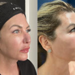 Mesh Brow Threads Before and After Photo by Dr. Emer and Dr. Sanan in West Hollywood California