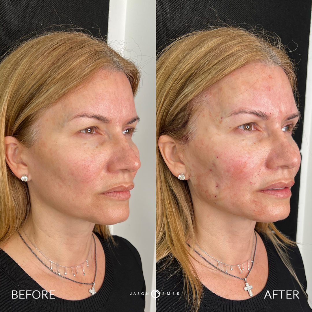 Mesh Brow Threads Before and After Photo by Dr. Emer and Dr. Sanan in West Hollywood California