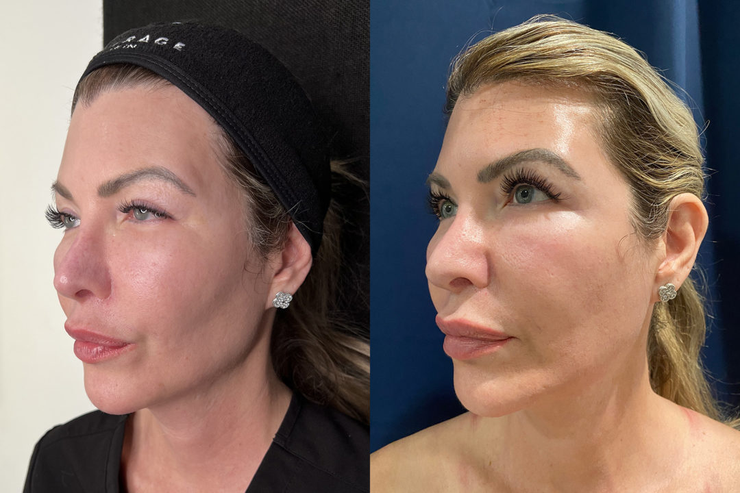 Mesh Brow Threads Before and After Photo by Dr. Emer and Dr. Sanan in West Hollywood California