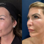 Mesh Brow Threads Before and After Photo by Dr. Emer and Dr. Sanan in West Hollywood California