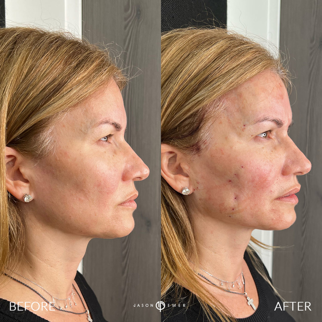 Mesh Brow Threads Before and After Photo by Dr. Emer and Dr. Sanan in West Hollywood California