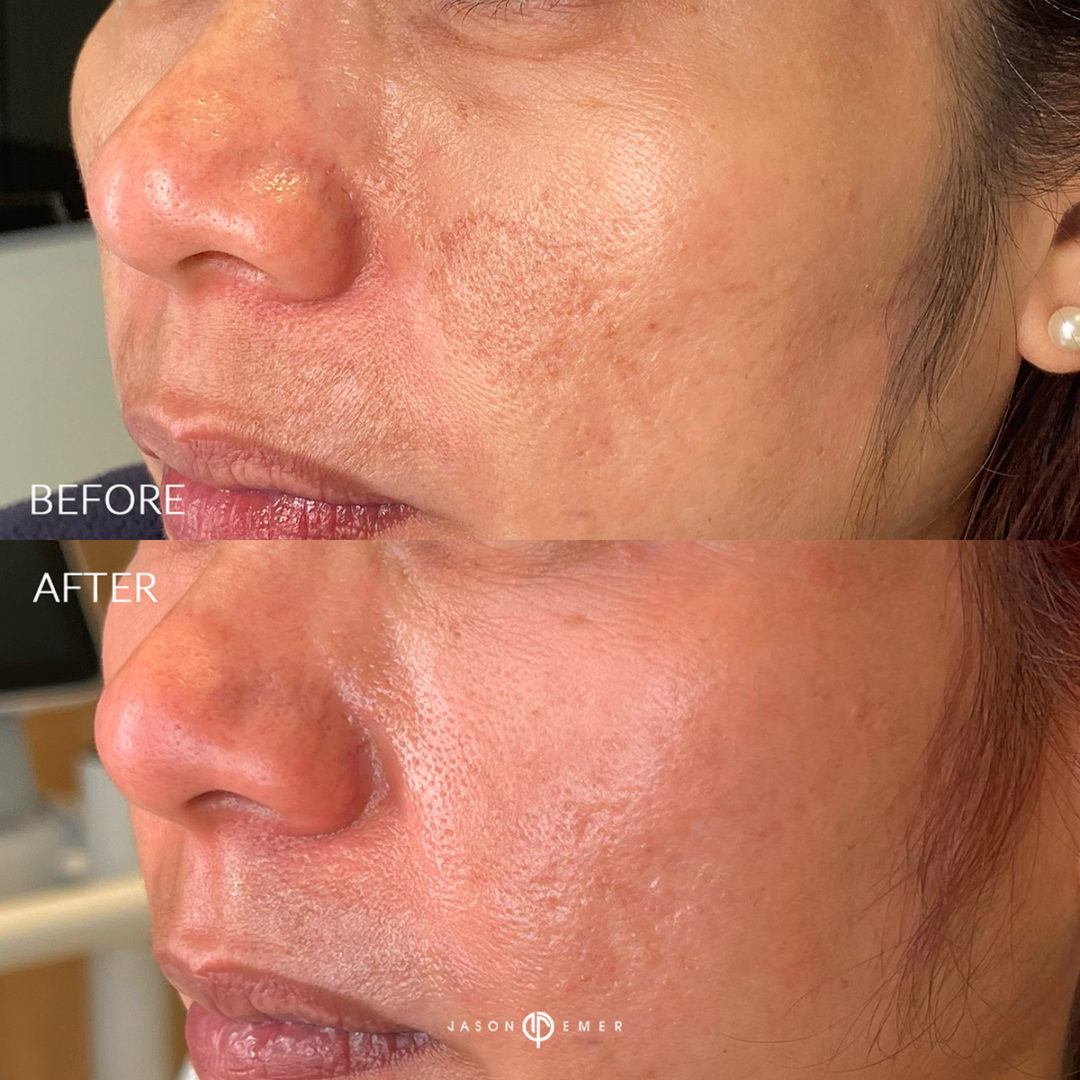 Microneedling Before and After Photo by Dr. Emer and Dr. Sanan in West Hollywood California