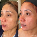 Microneedling Before and After Photo by Dr. Emer and Dr. Sanan in West Hollywood California