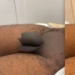 Penile Filler Before and After Photo by Dr. Emer and Dr. Sanan in West Hollywood California