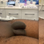 Penile Filler Before and After Photo by Dr. Emer and Dr. Sanan in West Hollywood California