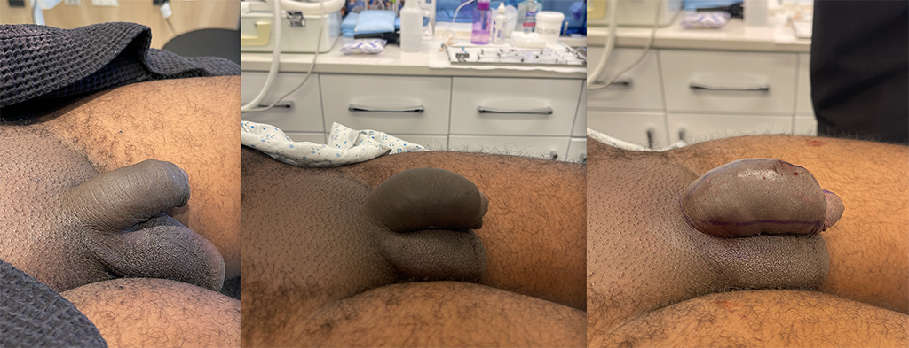 Penile Filler Before and After Photo by Dr. Emer and Dr. Sanan in West Hollywood California