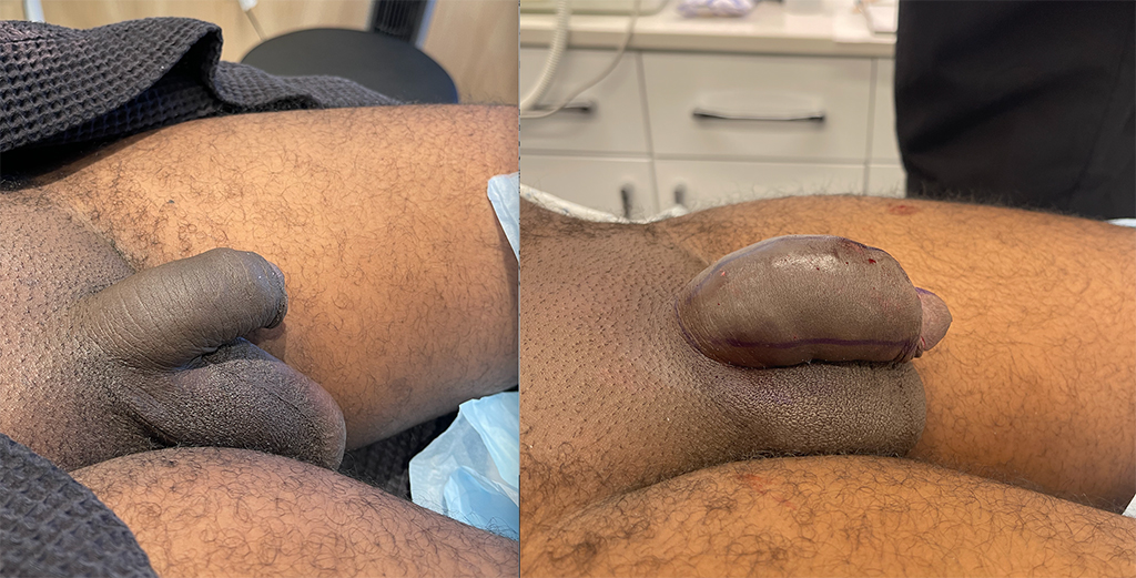 Penile Filler Before and After Photo by Dr. Emer and Dr. Sanan in West Hollywood California