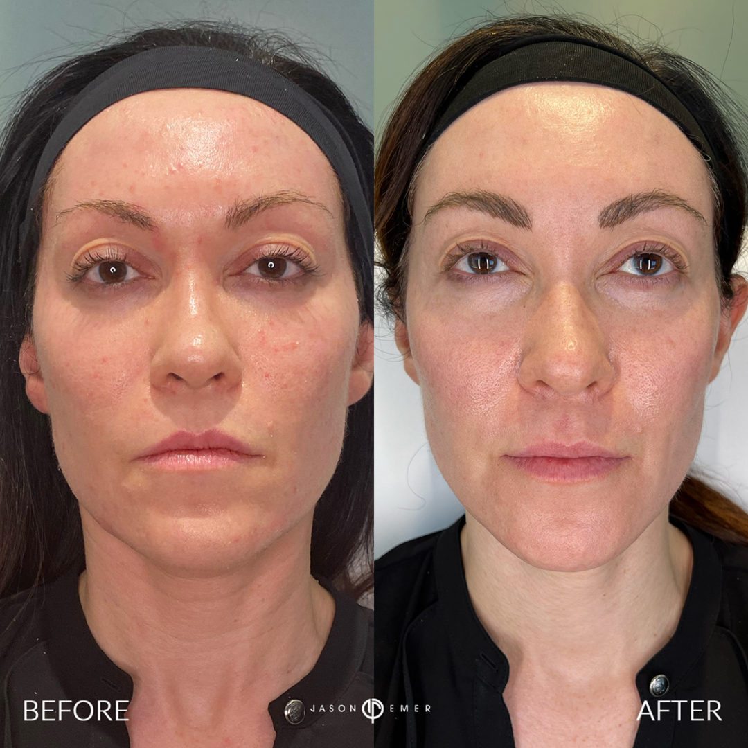 Sculptra Before and After Photo by Dr. Emer and Dr. Sanan in West Hollywood California