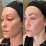 Sculptra Before and After Photo by Dr. Emer and Dr. Sanan in West Hollywood California