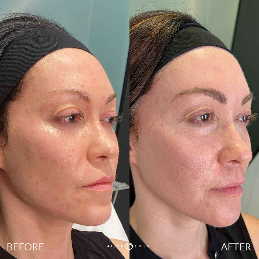 Sculptra Before and After Photo by Dr. Emer and Dr. Sanan in West Hollywood California