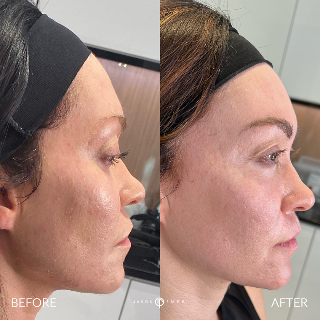 Sculptra Before and After Photo by Dr. Emer and Dr. Sanan in West Hollywood California