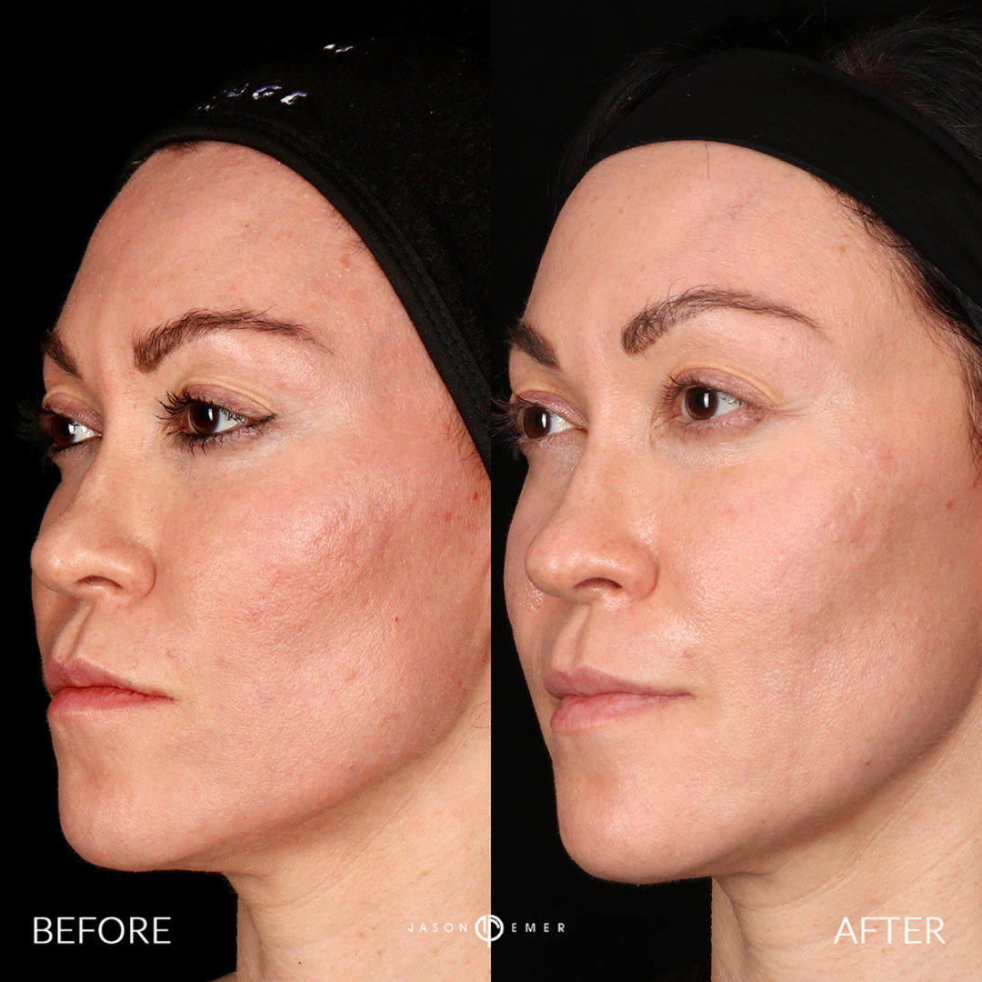 Sculptra Before and After Photo by Dr. Emer and Dr. Sanan in West Hollywood California