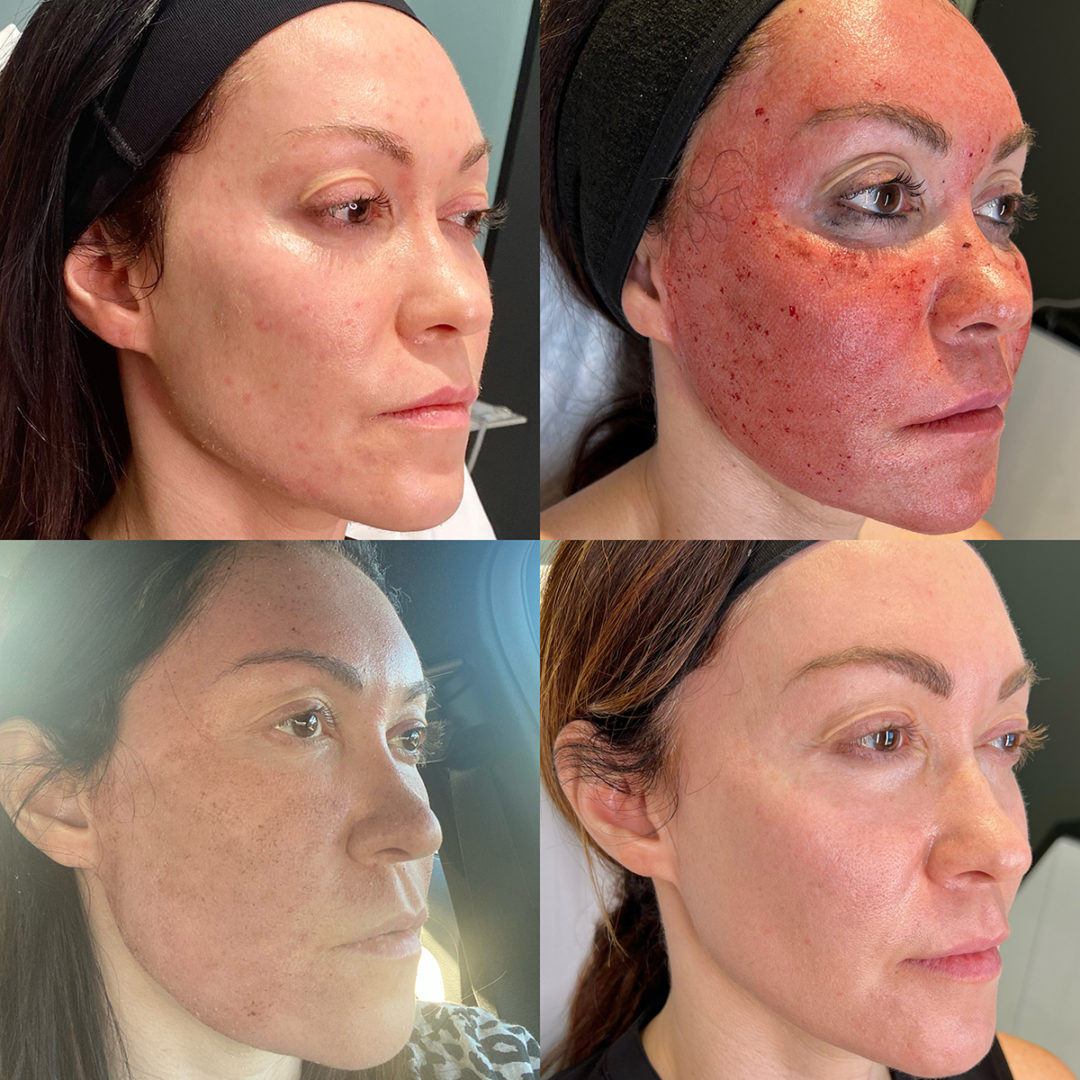 Sculptra Before and After Photo by Dr. Emer and Dr. Sanan in West Hollywood California