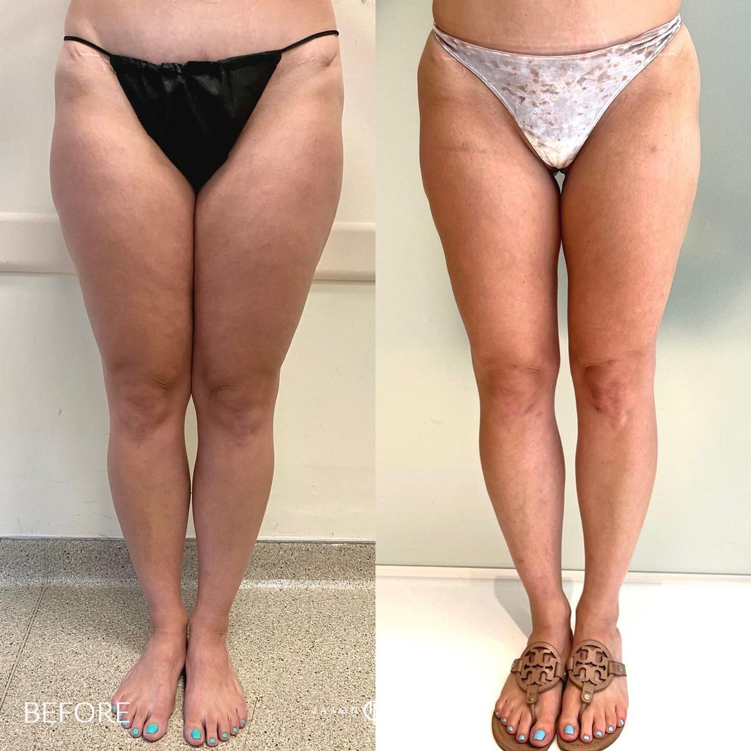 Spiral Thigh Lift Before and After Photo by Dr. Emer and Dr. Sanan in West Hollywood California