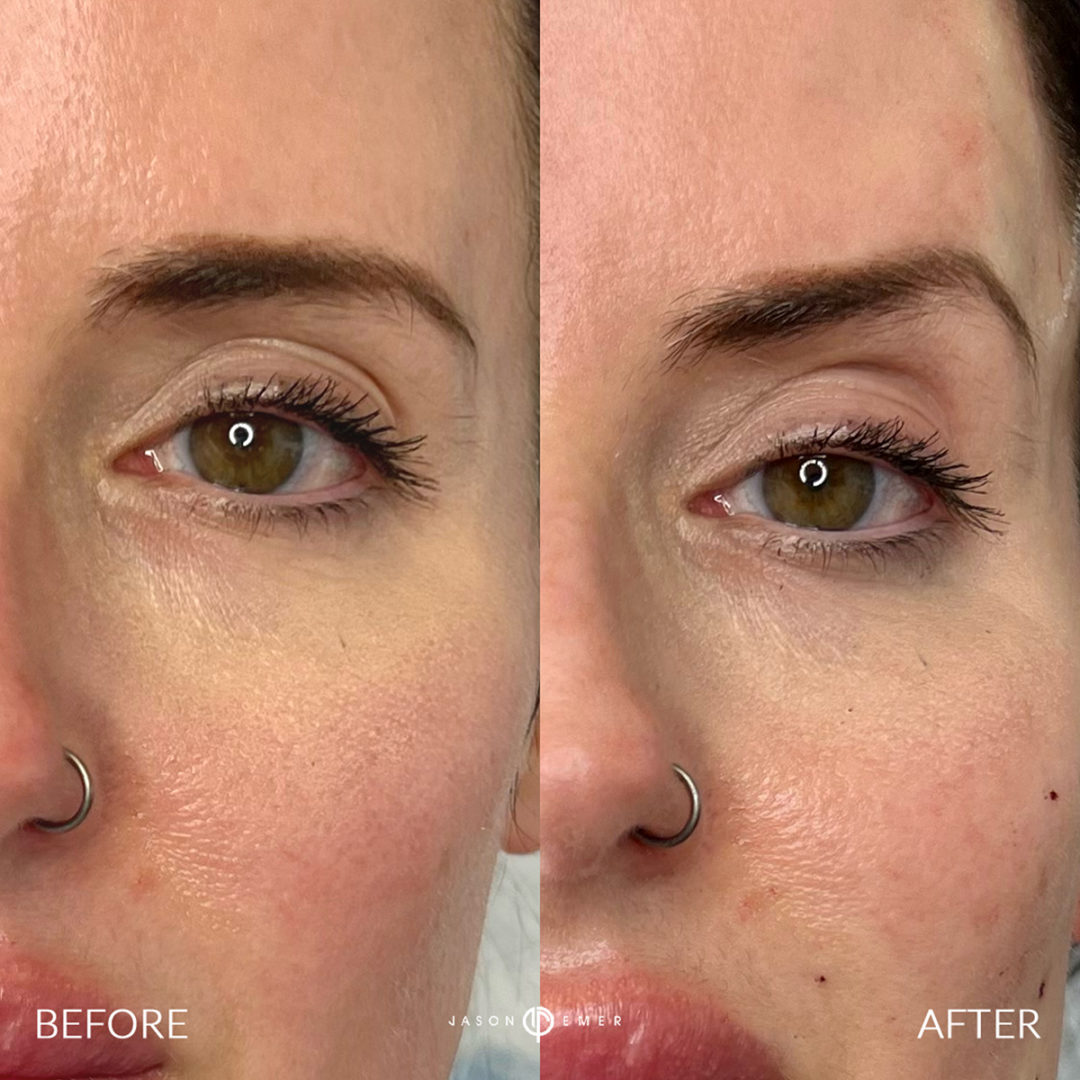 Thread Lift for The Brows Before and After Photo by Dr. Emer and Dr. Sanan in West Hollywood California