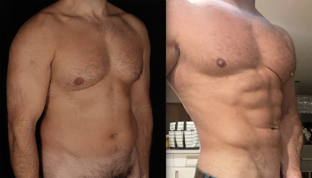 Power-assisted liposuction Before and After Photo by Dr. Emer and Dr. Sanan in West Hollywood California