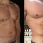 Power-assisted liposuction Before and After Photo by Dr. Emer and Dr. Sanan in West Hollywood California