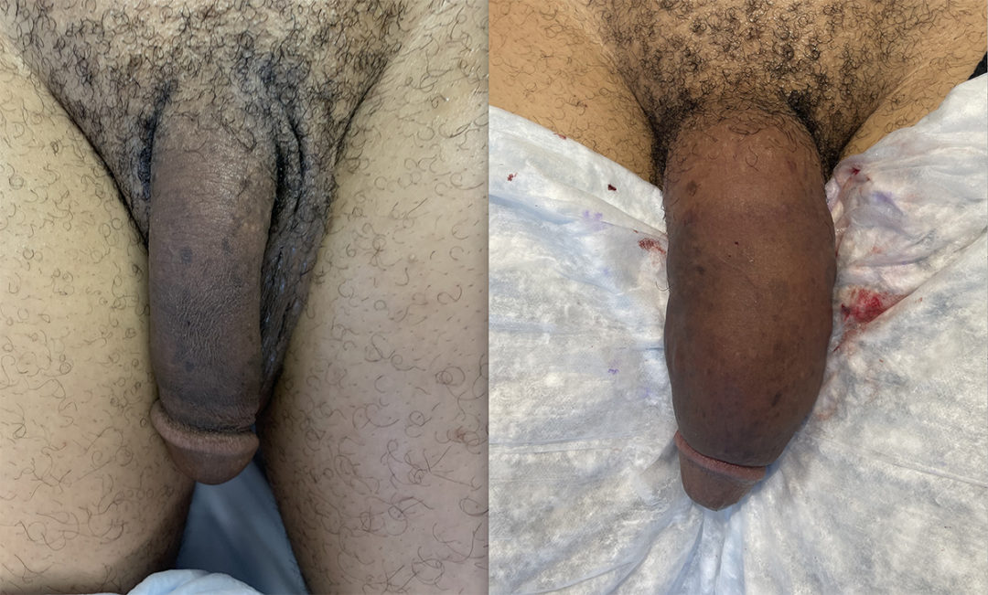 Penile Filler Before and After Photo by Dr. Emer and Dr. Sanan in West Hollywood California