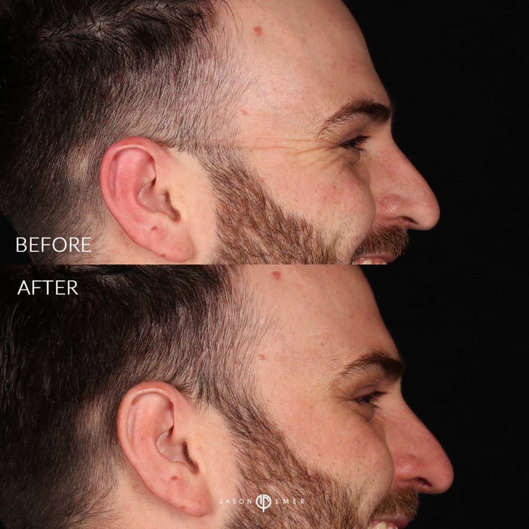 Botox Before and After Photo by Dr. Emer and Dr. Sanan in West Hollywood California