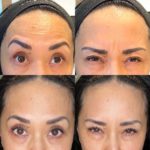 Botox Before and After Photo by Dr. Emer and Dr. Sanan in West Hollywood California